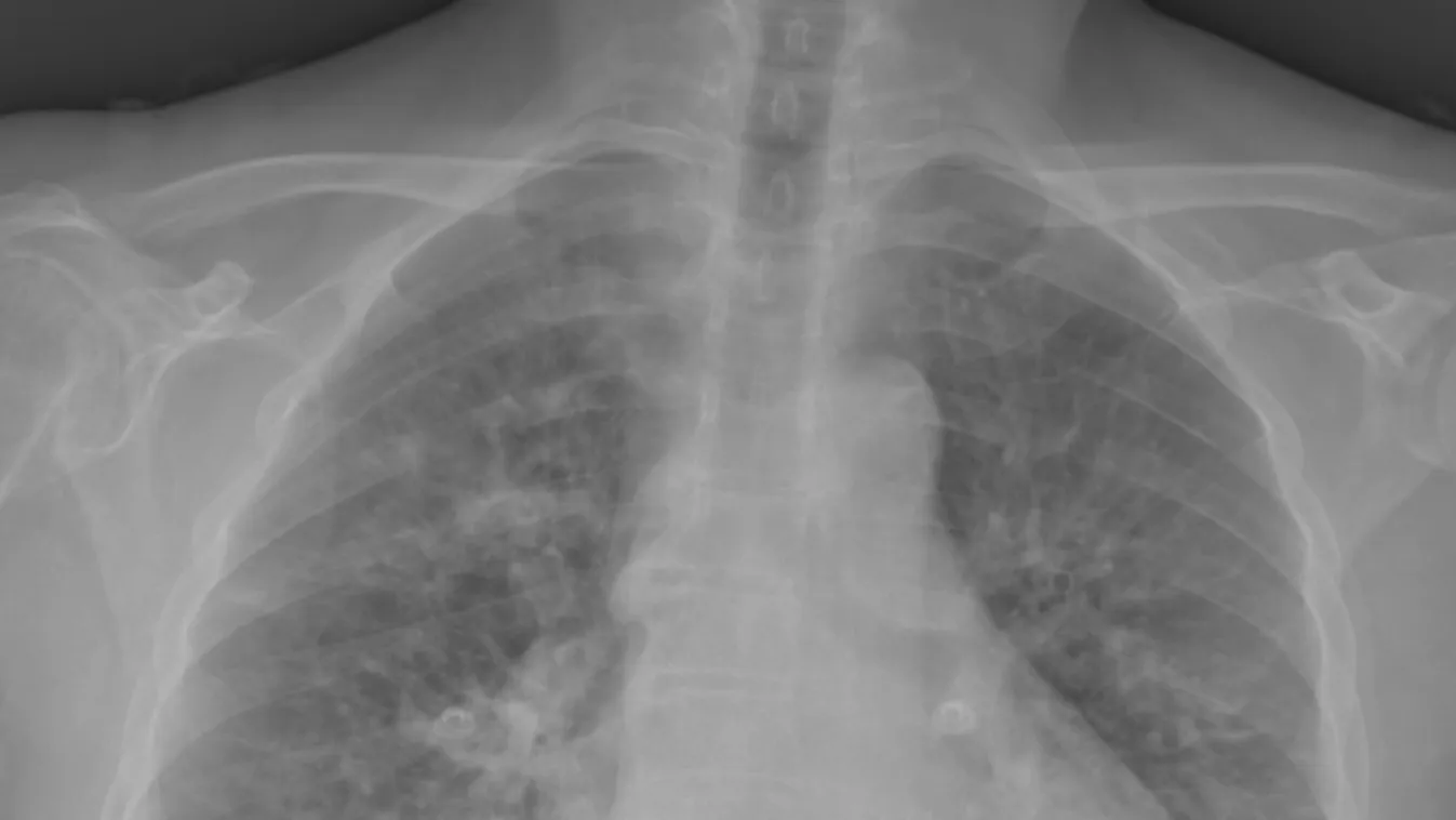 Poszt-Covid lépésről lépésre: így ismerd fel és kezeld a rejtélyes betegséget!