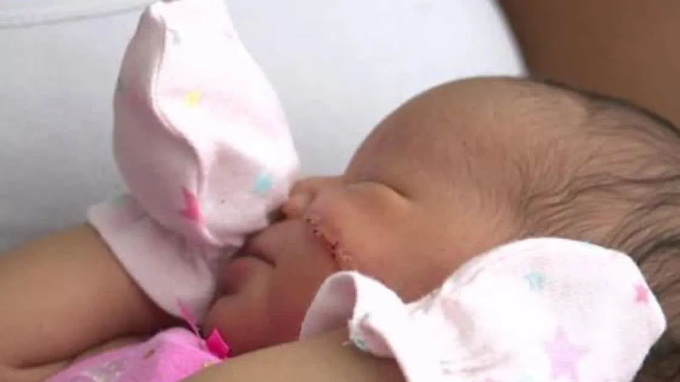 Végigvágta a baba arcát császározás közben a figyelmetlen doki - Fotó