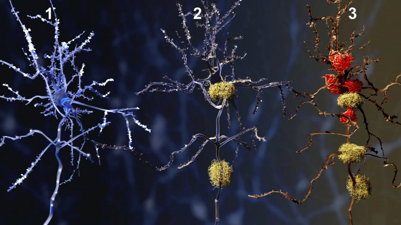 Tudományos áttörés: megkezdik az első, Alzheimer-kór elleni vakcina tesztelését embereken