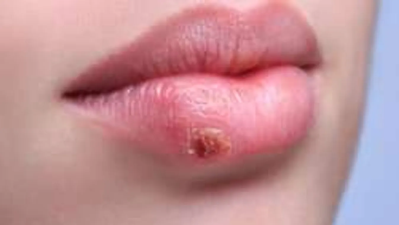 Végre megvan a herpeszre a csodaszer!