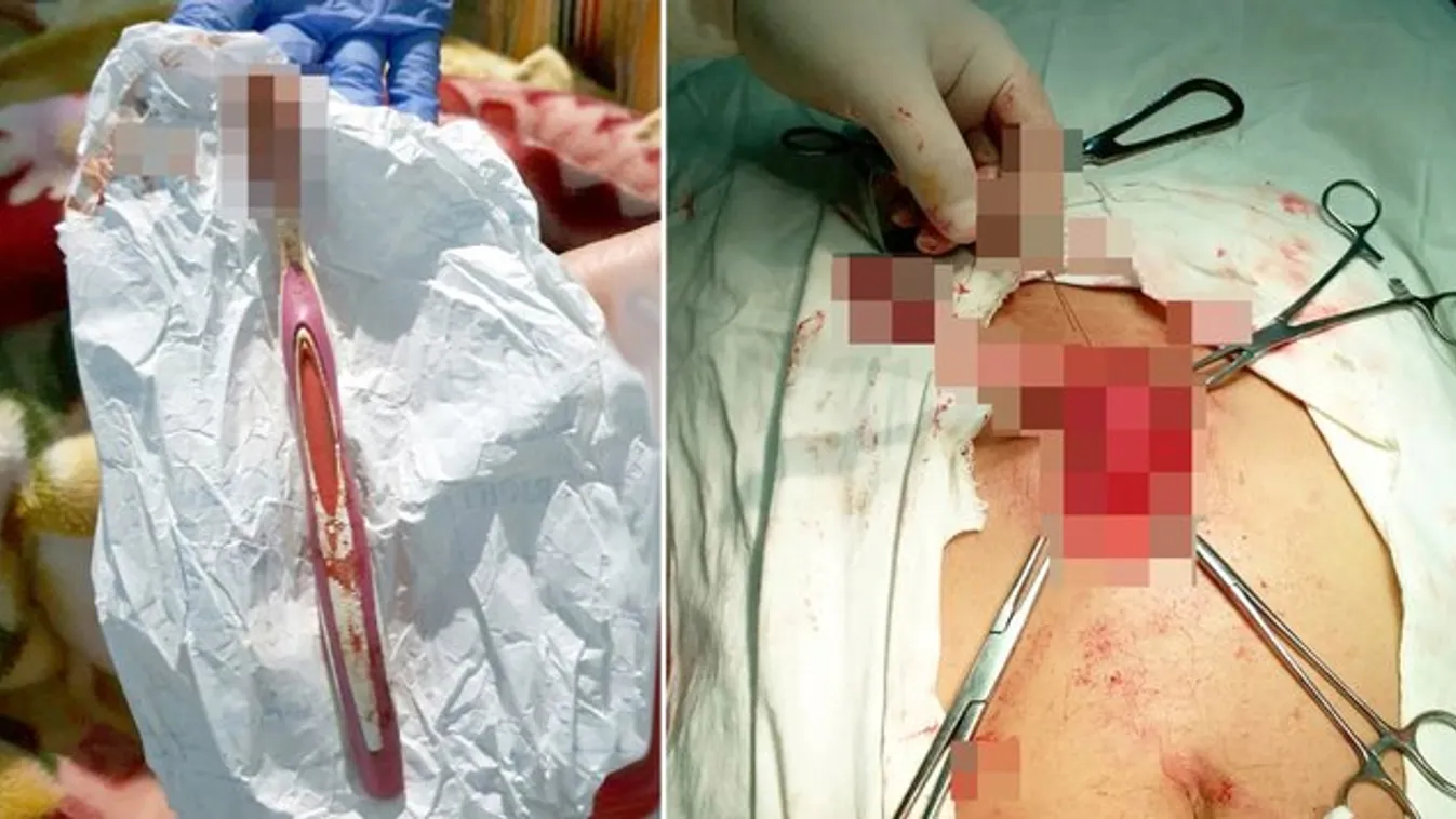 Sokkot kaptak az orvosok: egy fogkefét operáltak ki a férfi gyomrából