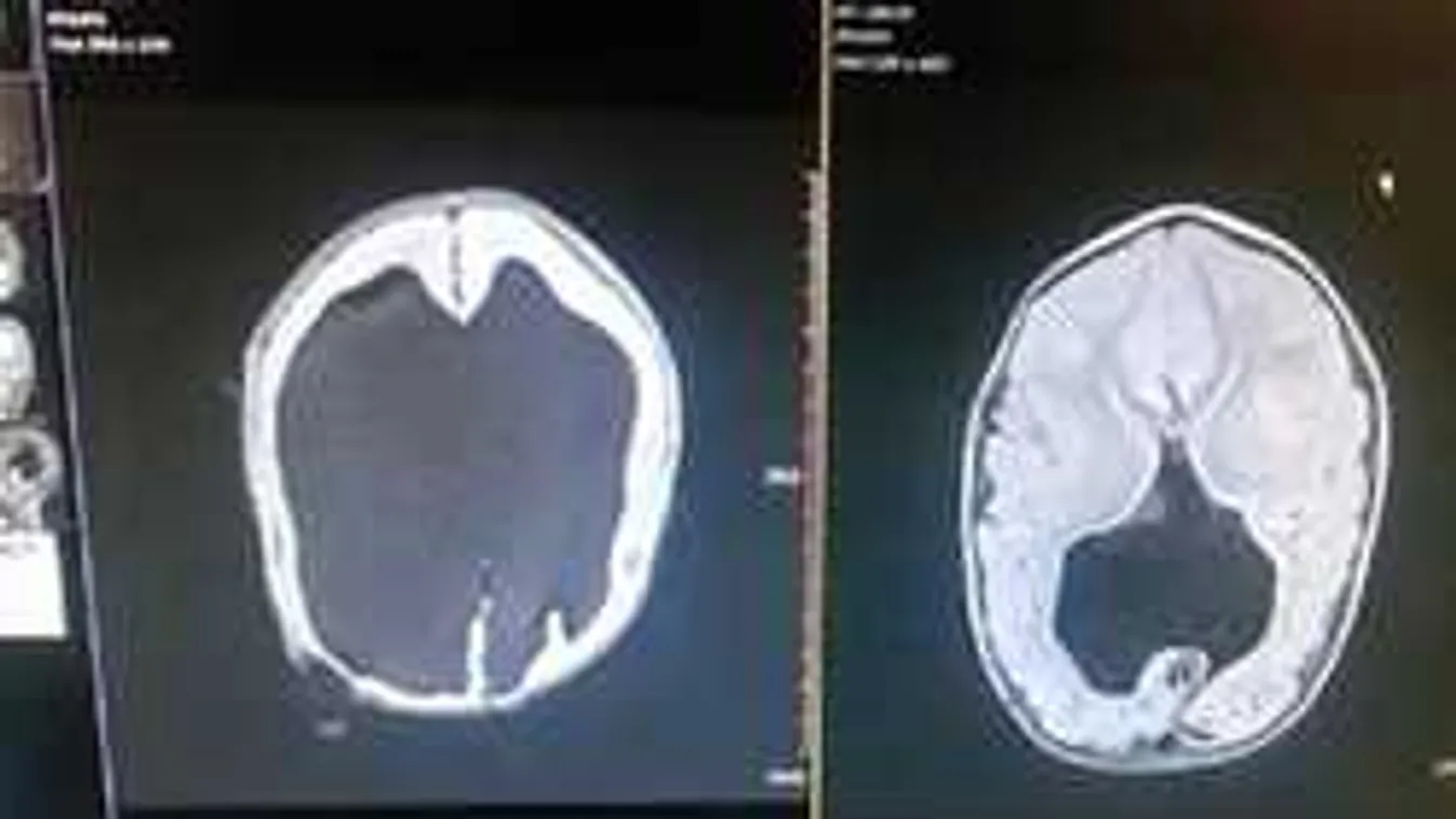 Nem volt esélye az életben maradásra a kisfiúnak