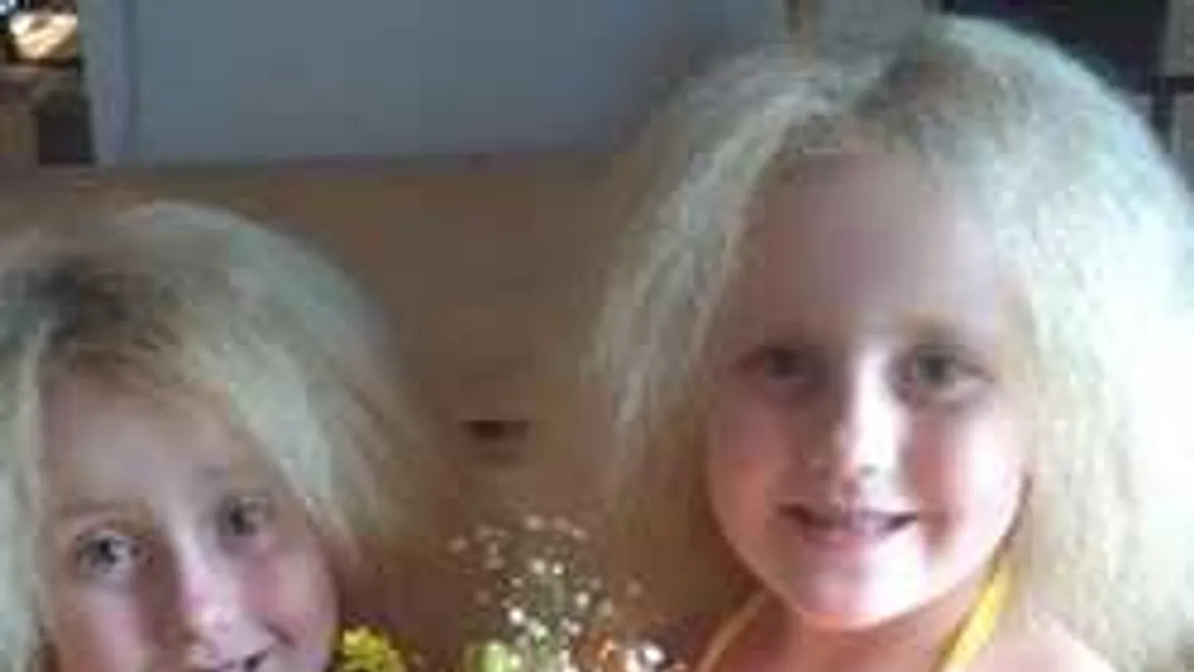 Bizarr genetikai állapot: Áram jár a két kislány hajában