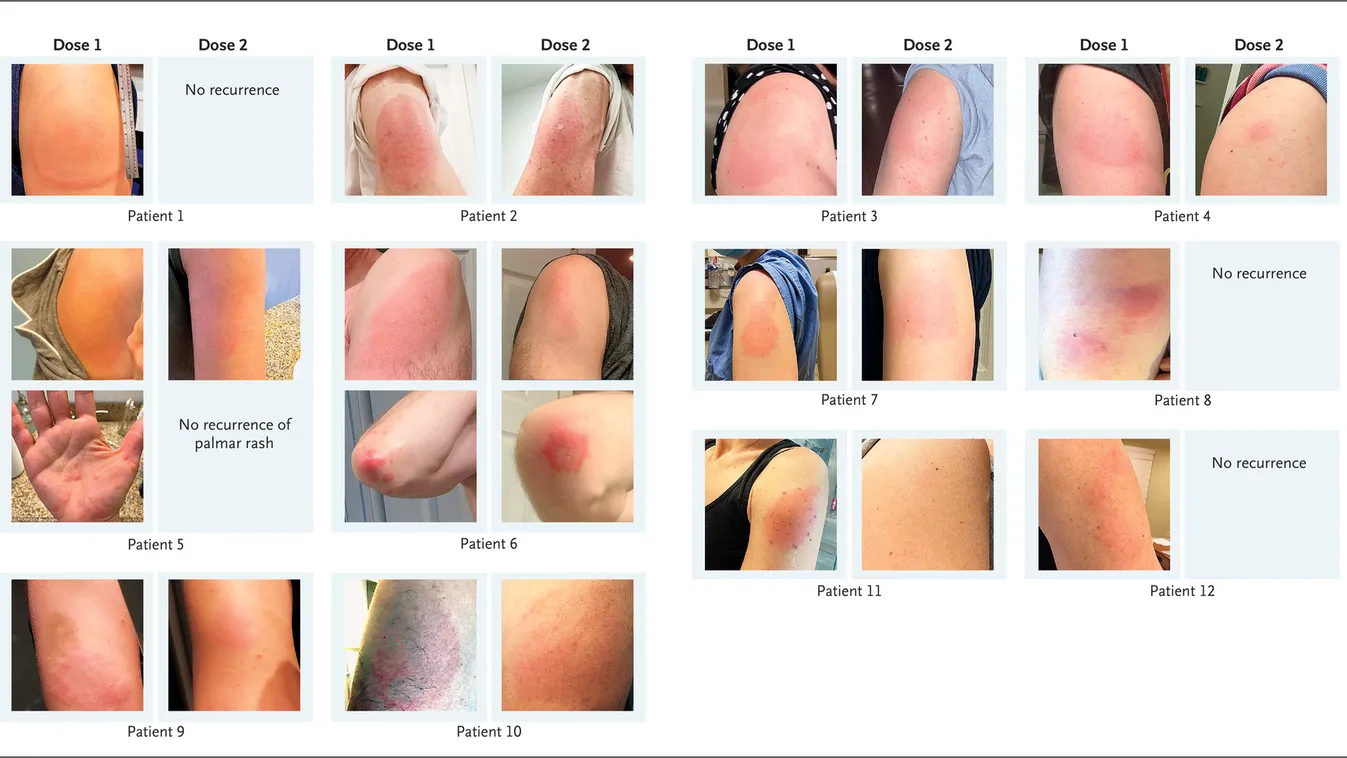Figyelmeztetnek az orvosok: fájdalmas bőrelváltozást okozhat az egyik vakcina