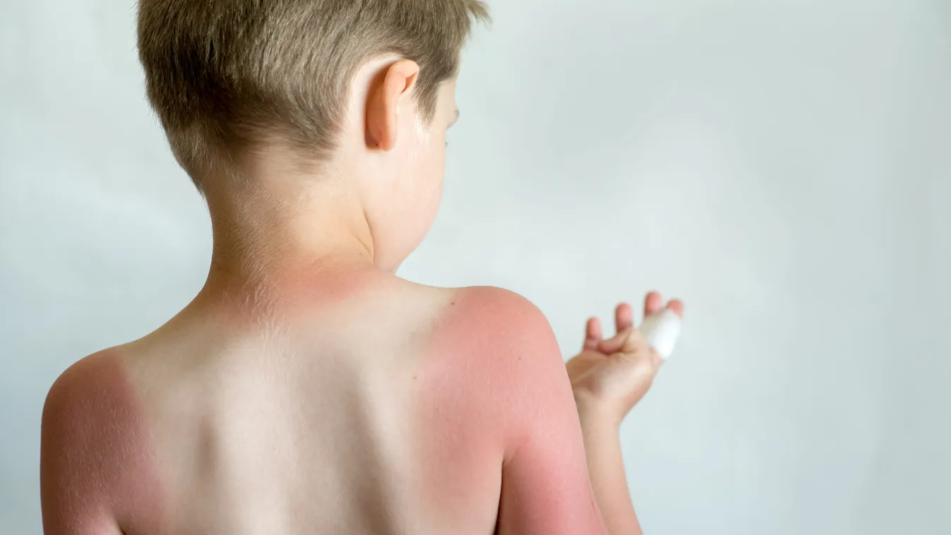 Sunblock,For,The,Child.,A,Strong,Sunburn,From,The,Boy's
