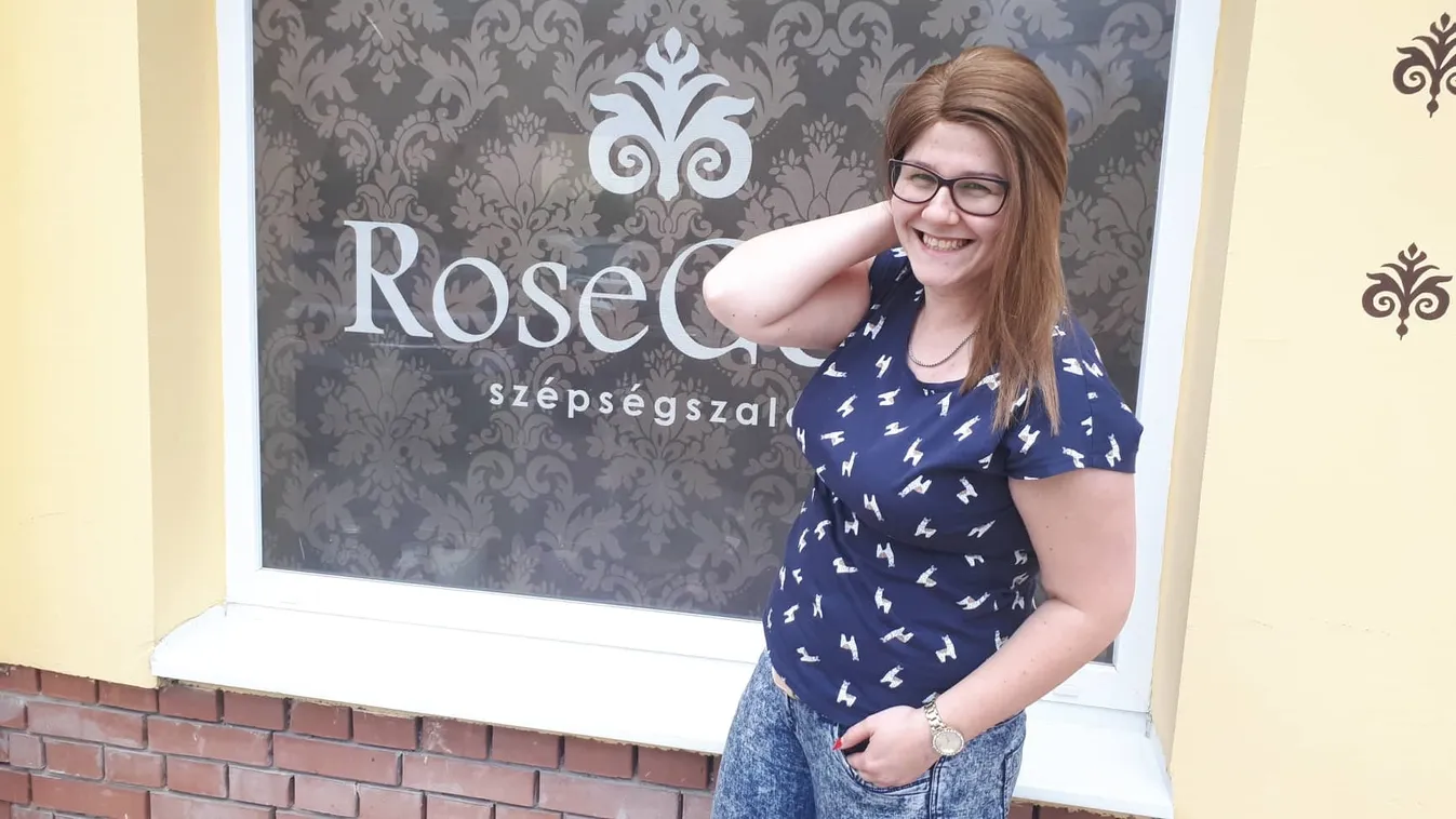 Rejtélyes betegség miatt lett kopasz a magyar lány