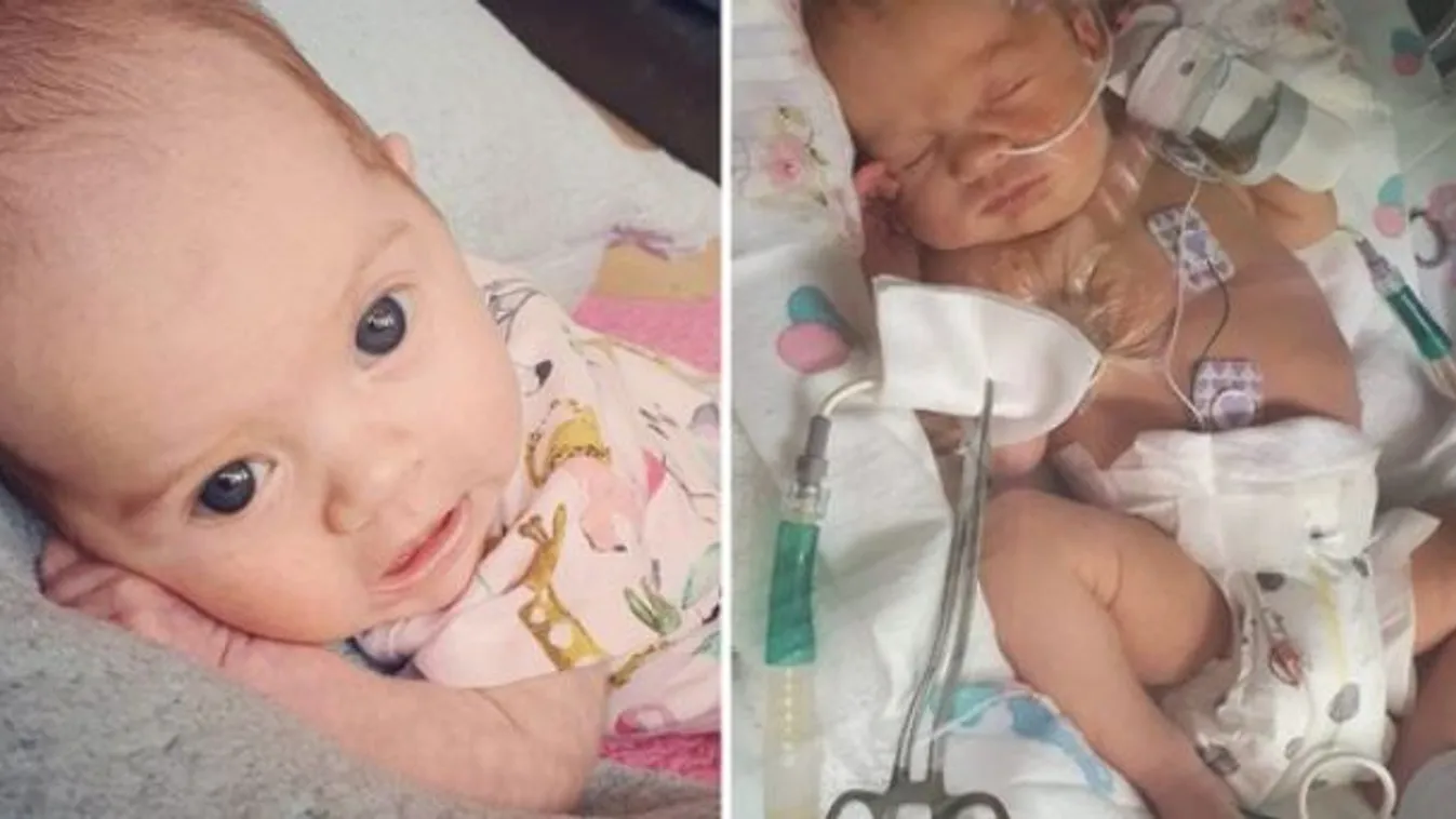 Megszakad a szív: annyit sírt a koraszülött kisbaba, hogy kilyukadt a tüdeje