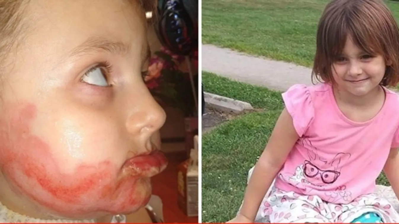 „Szívszorító, csúnyának tartja magát” – borzalmasan megégett a 6 éves kislány arca a kézfertőtlenítőtől
