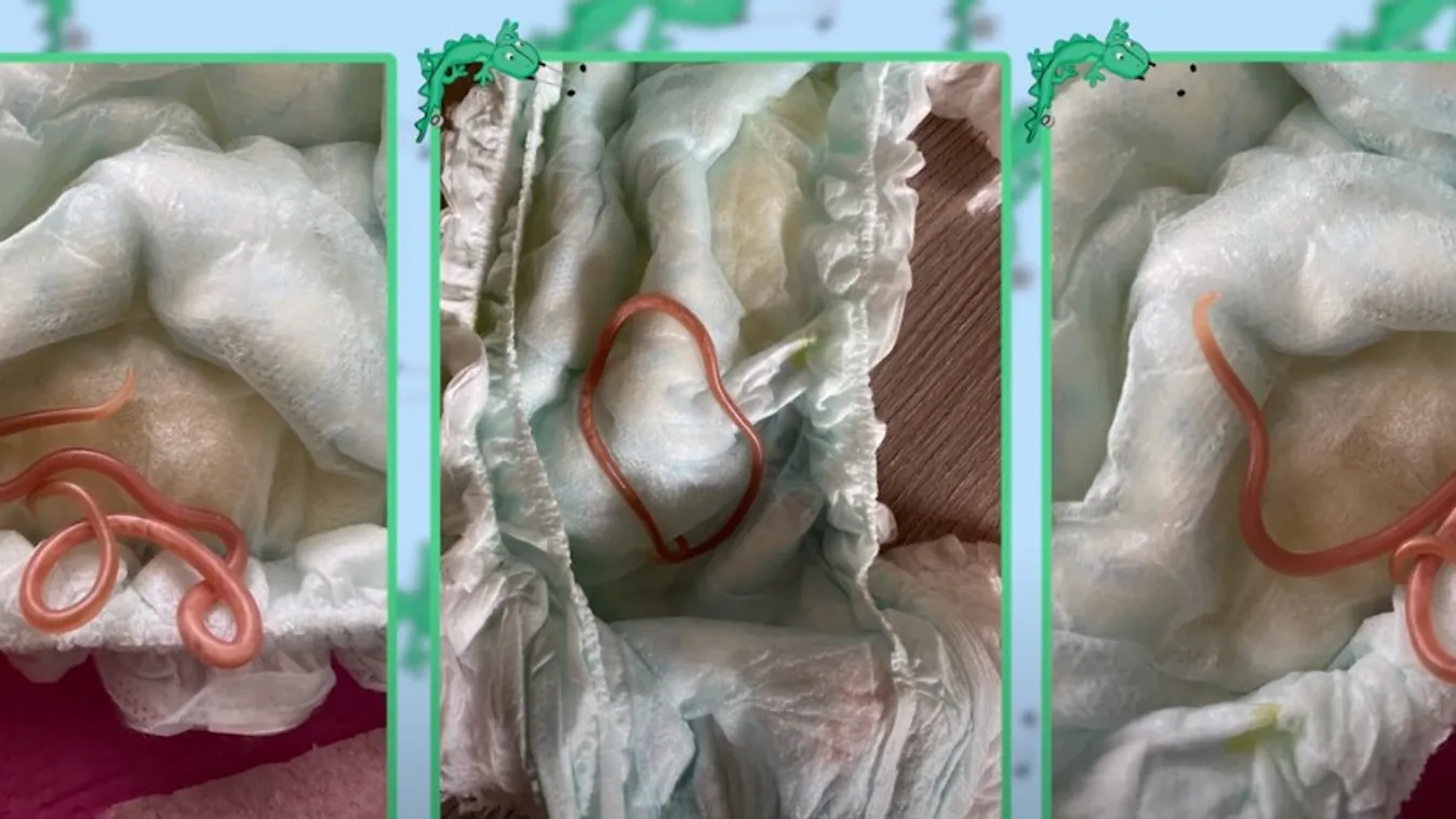 Gigantikus féreg mászott ki a magyar kisbabából, ezt mondta a gyermekorvos