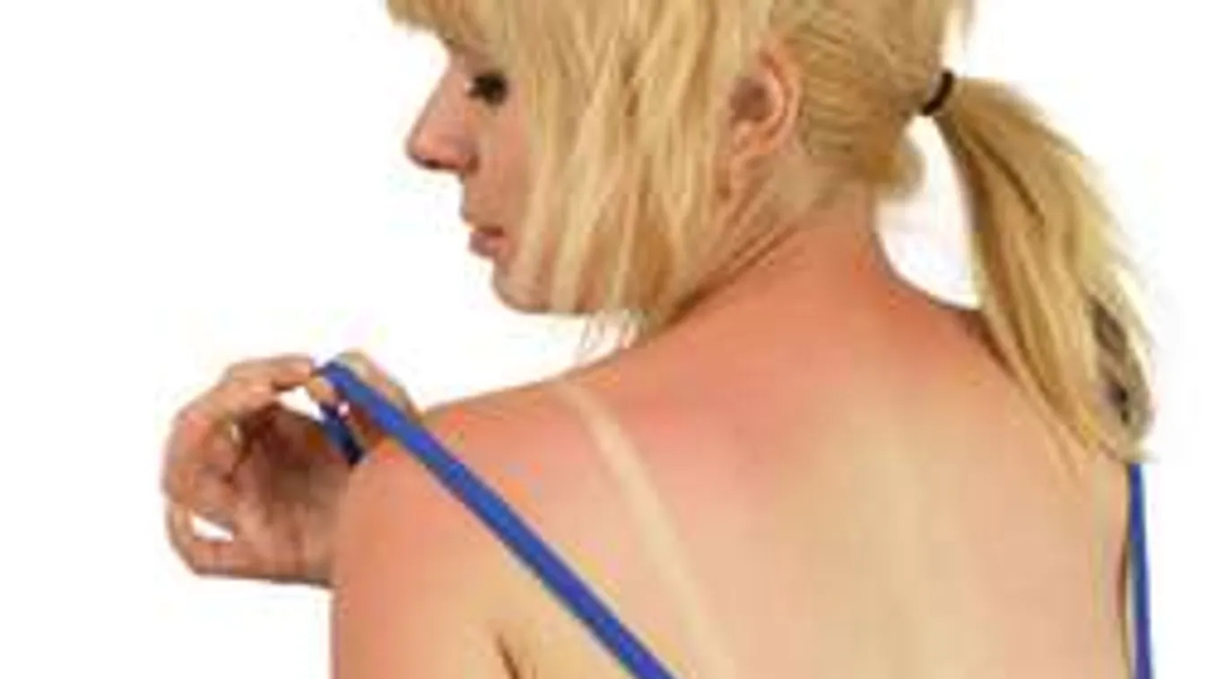 Leégtél a napon? Meglepő, de ezt kell tenned legelőször