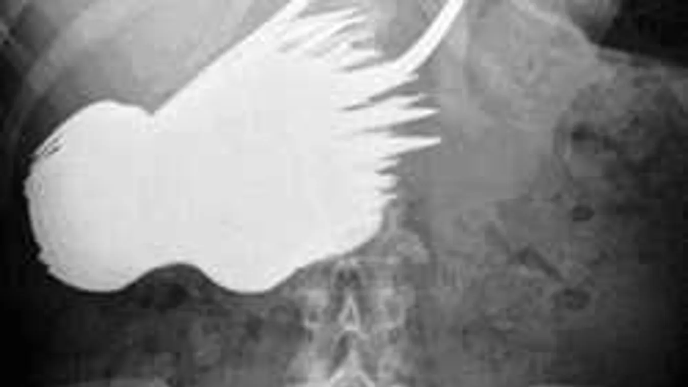 Hajmeresztő röntgenfotók: tárgyak, amiket emberek fenekében találtak a dokik