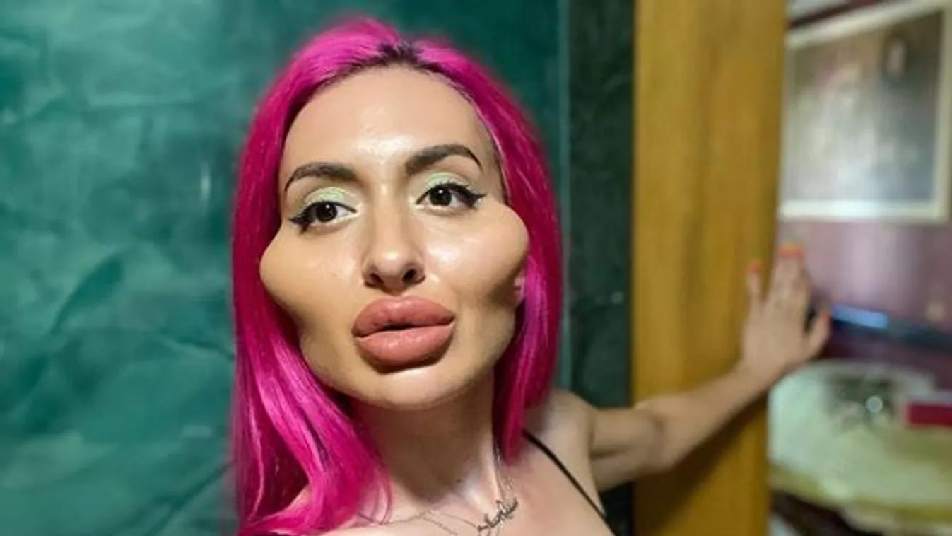 Mit művelt az arcával? Teljesen eltorzult a feje a házi plasztikától a fiatal nőnek