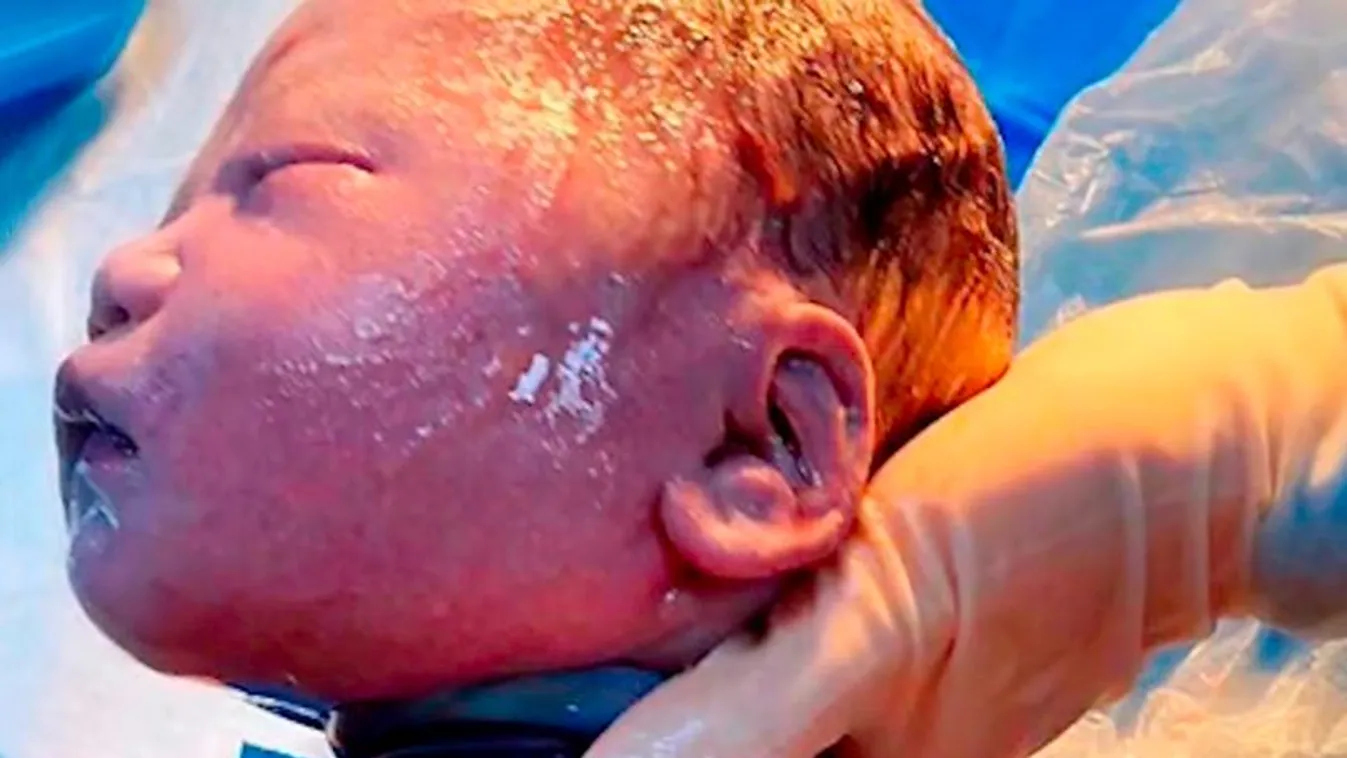 Sokkolta az orvosokat: hatszor tekeredett a köldökzsinór az újszülött nyaka köré