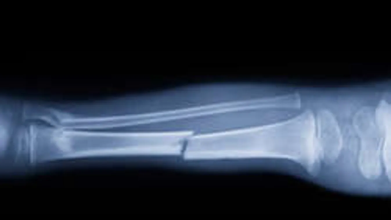 Döbbenetes módszerrel gyógyíthatják a csonttöréseket