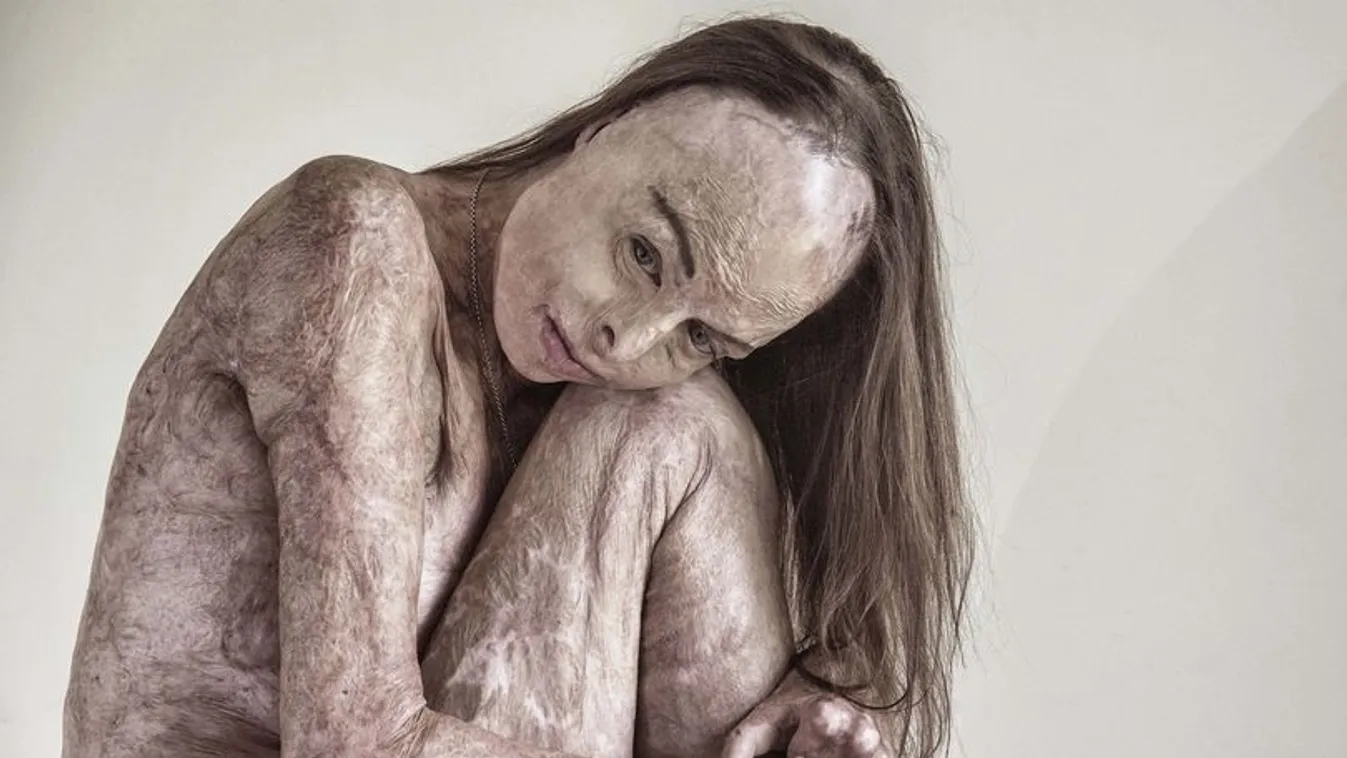 Meztelenül pózolt a szépségkirálynő, akinek a teste 85 százaléka megégett