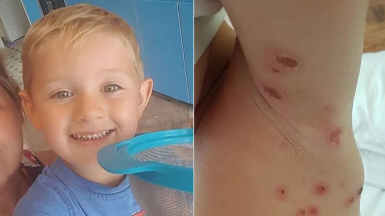 Rémálommá vált a családi nyaralás: élve felfalták a poloskák a 4 éves gyereket