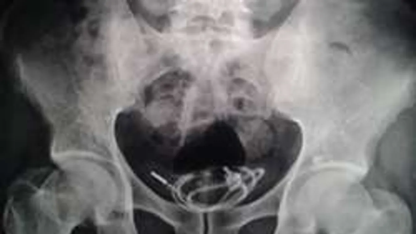 Sokkot kaptak az orvosok, amikor rendelőbe került a maszturbáló férfi