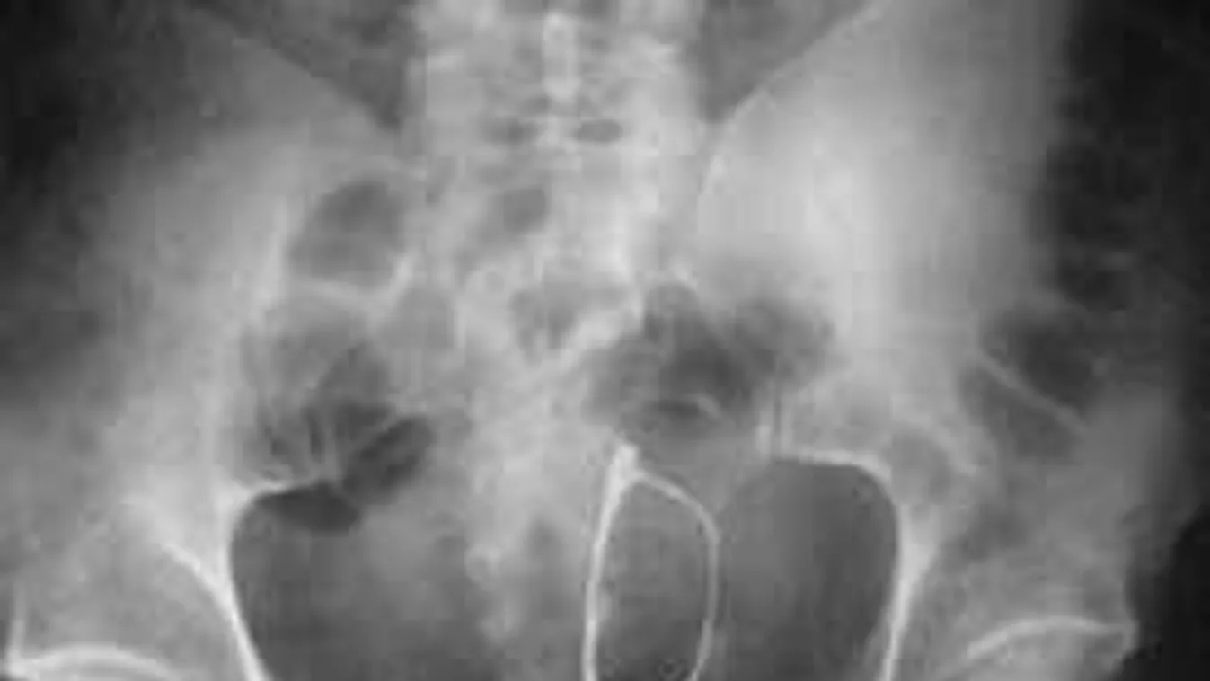 Durva röntgenfelvételek - a legbizarrabb tárgyak, melyeket nők vaginájában találtak!