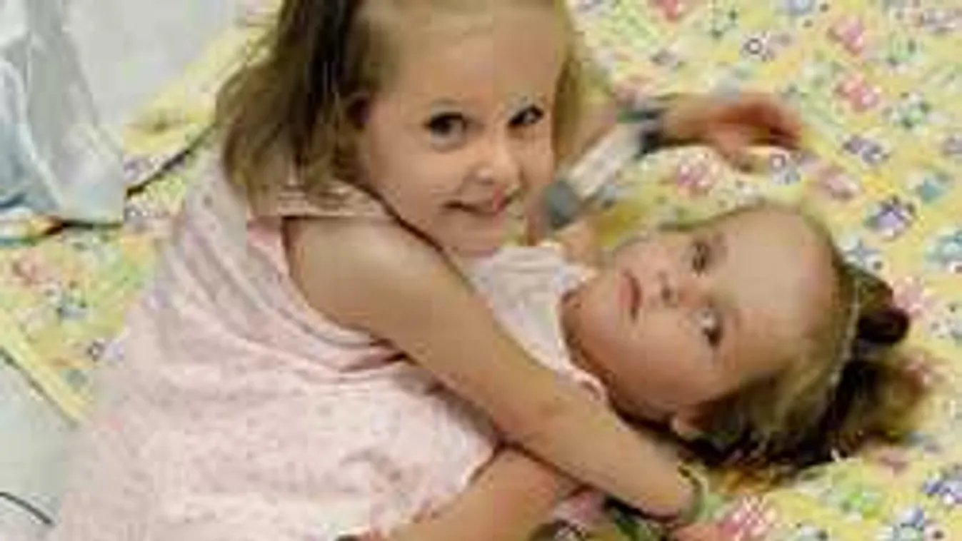 26 órás műtéttel választották szét a sziámi ikerlányokat, így néznek ki most