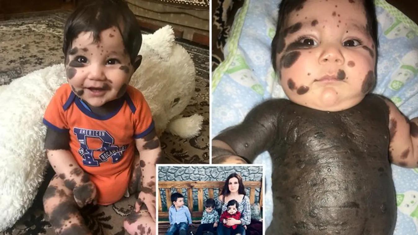 Döbbenet: a tündéri kisbaba testének 80 százalékát anyajegyek fedik – fotók