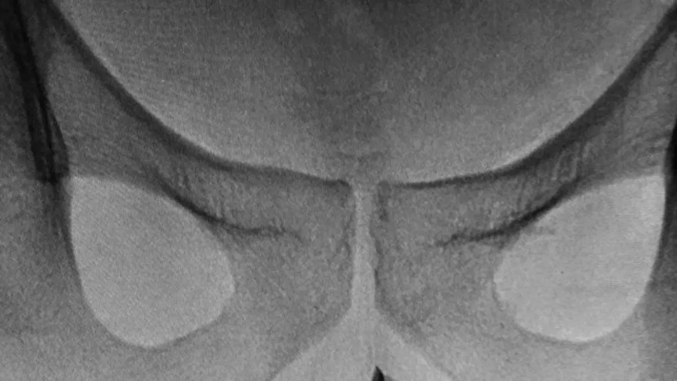 Sokkot kapott az orvos, nagyon durva mit talált a páciens legintimebb részében