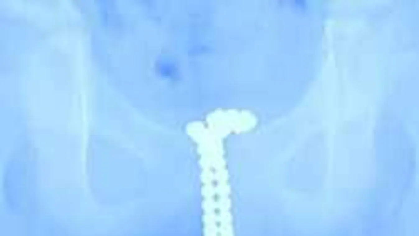 Hajmeresztő: egy kisfiú péniszéből olyan játékot halásztak ki, hogy el sem hiszed!