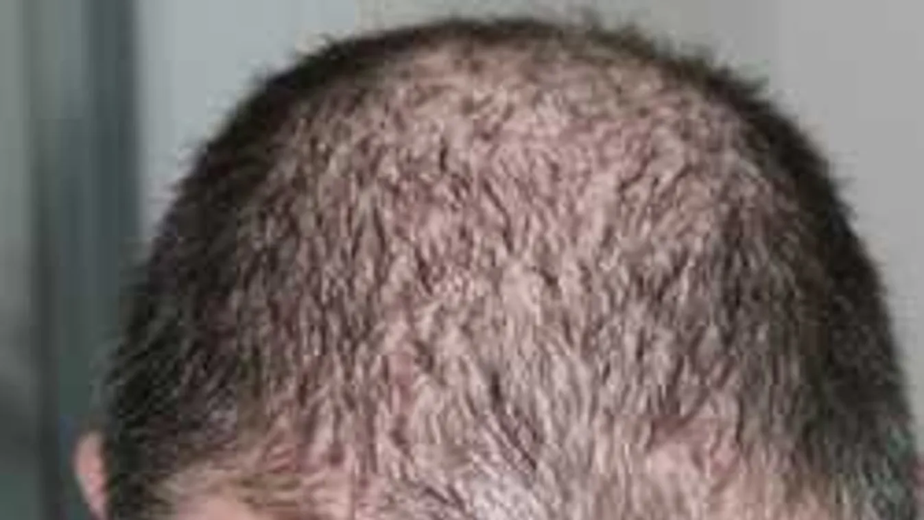 Döbbenetes fordulat kopaszság-ügyben: 2 mm haj 6 nap alatt, elképesztő!