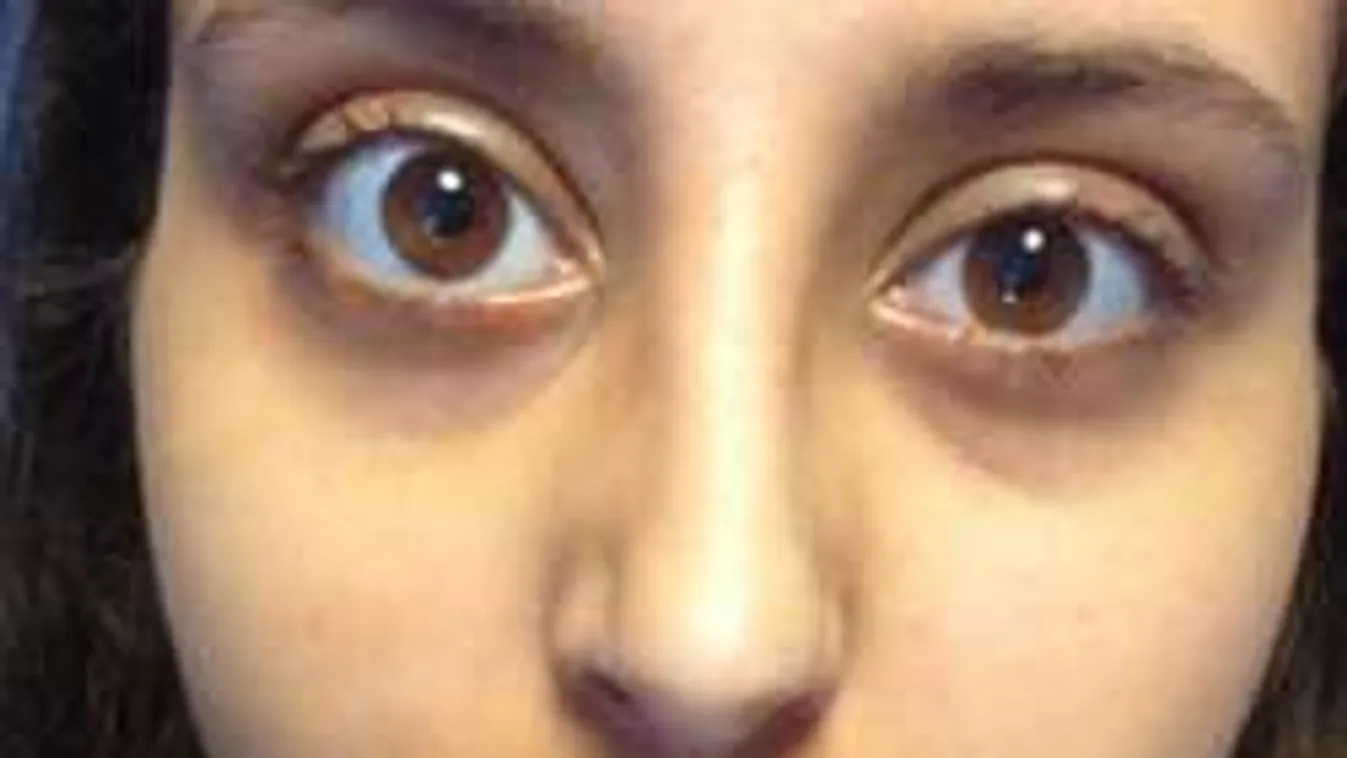 Paraziták ették a szemét!