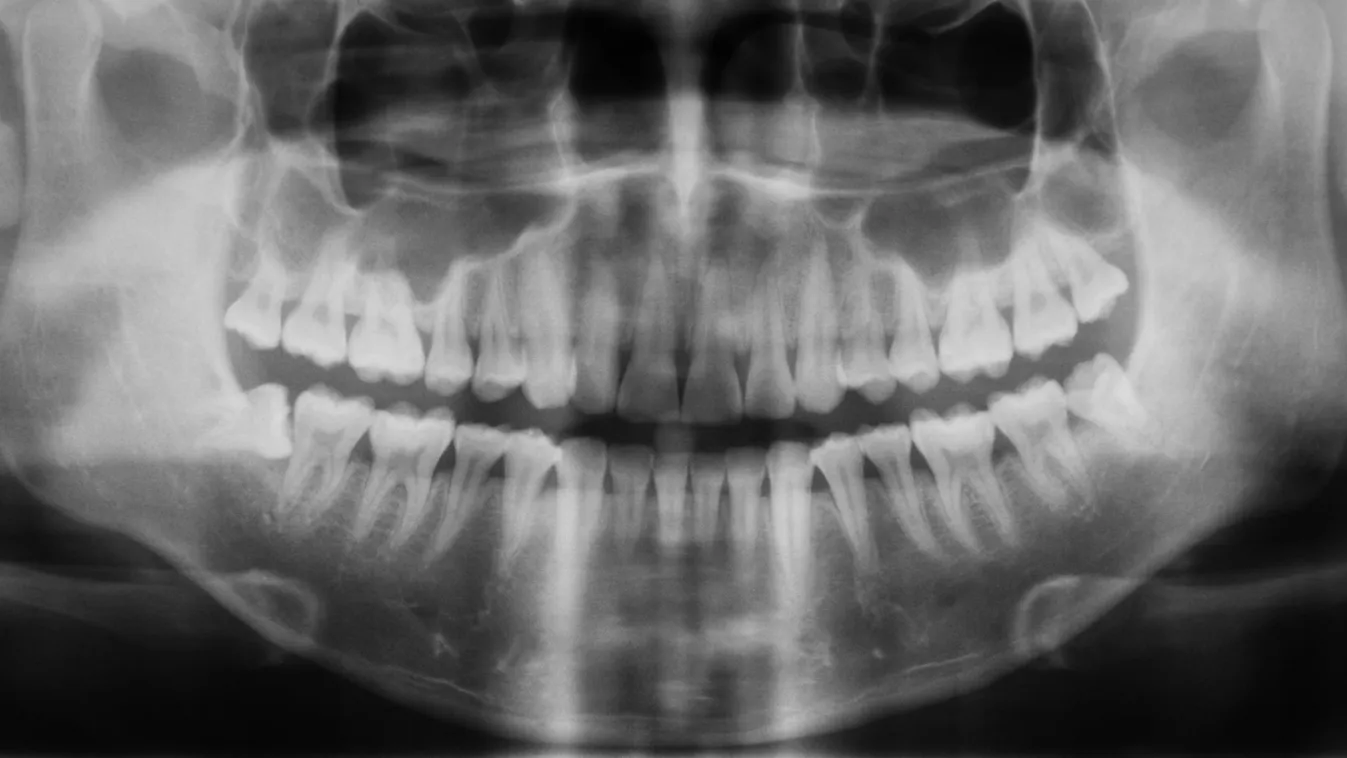 A röntgen egyértelműen kimutatta: eltörte a fogorvos a betege állkapcsát