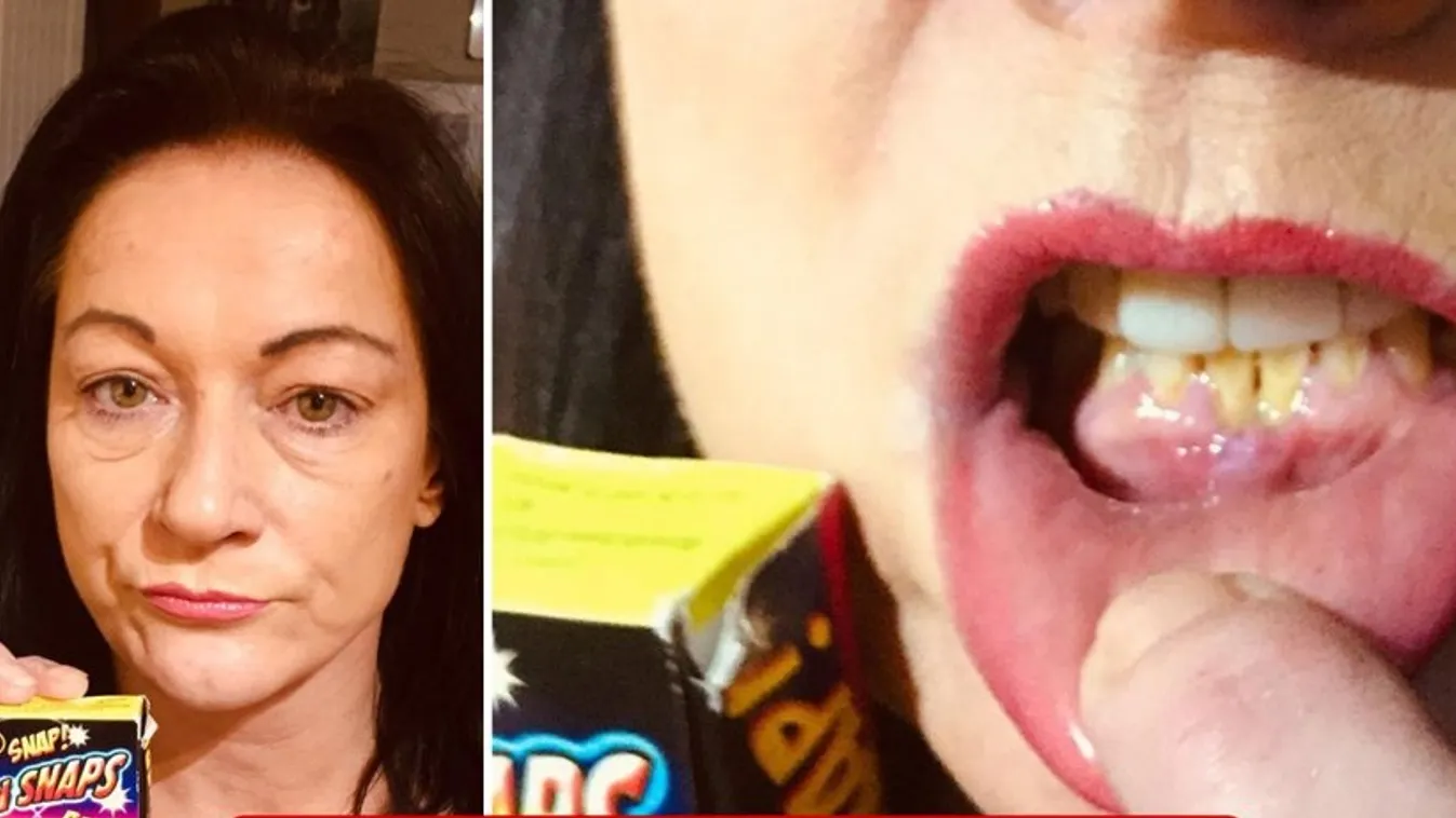 Durván leégett egy édesanya szája, aki cukorkának nézte a tűzijátékot