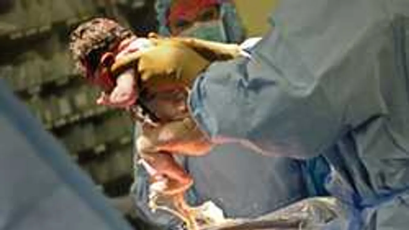 10 dolog, amit nem tudtál a császármetszésről