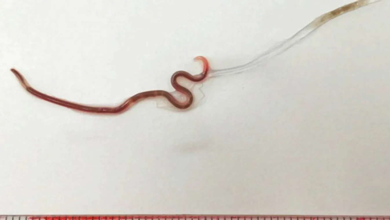 Élő féreg bújt a nő mandulájába, az elsápadt orvosok szedték ki