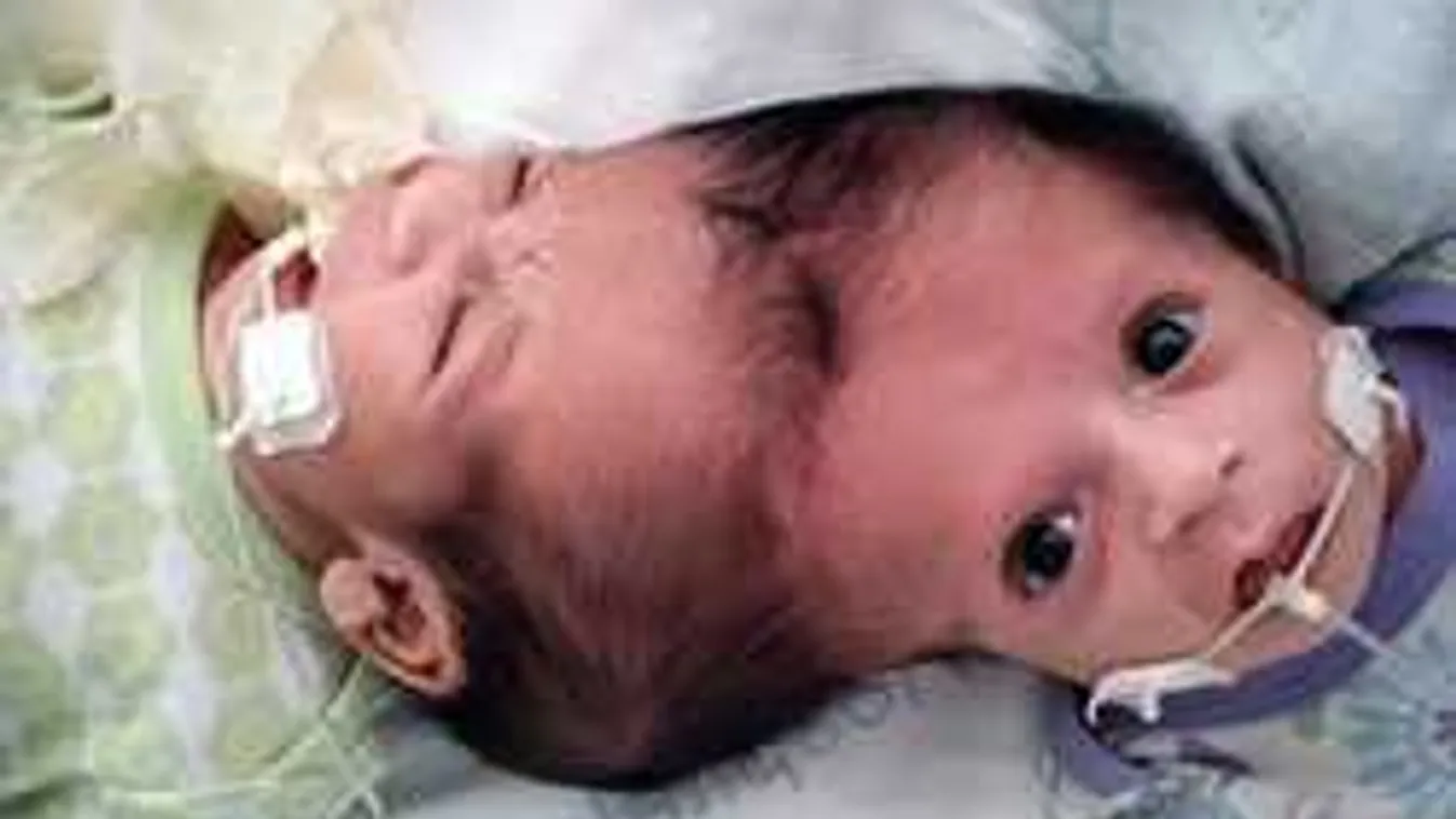 Orvosi csoda: Ez történt a műtét után a sziámi ikerlányokkal