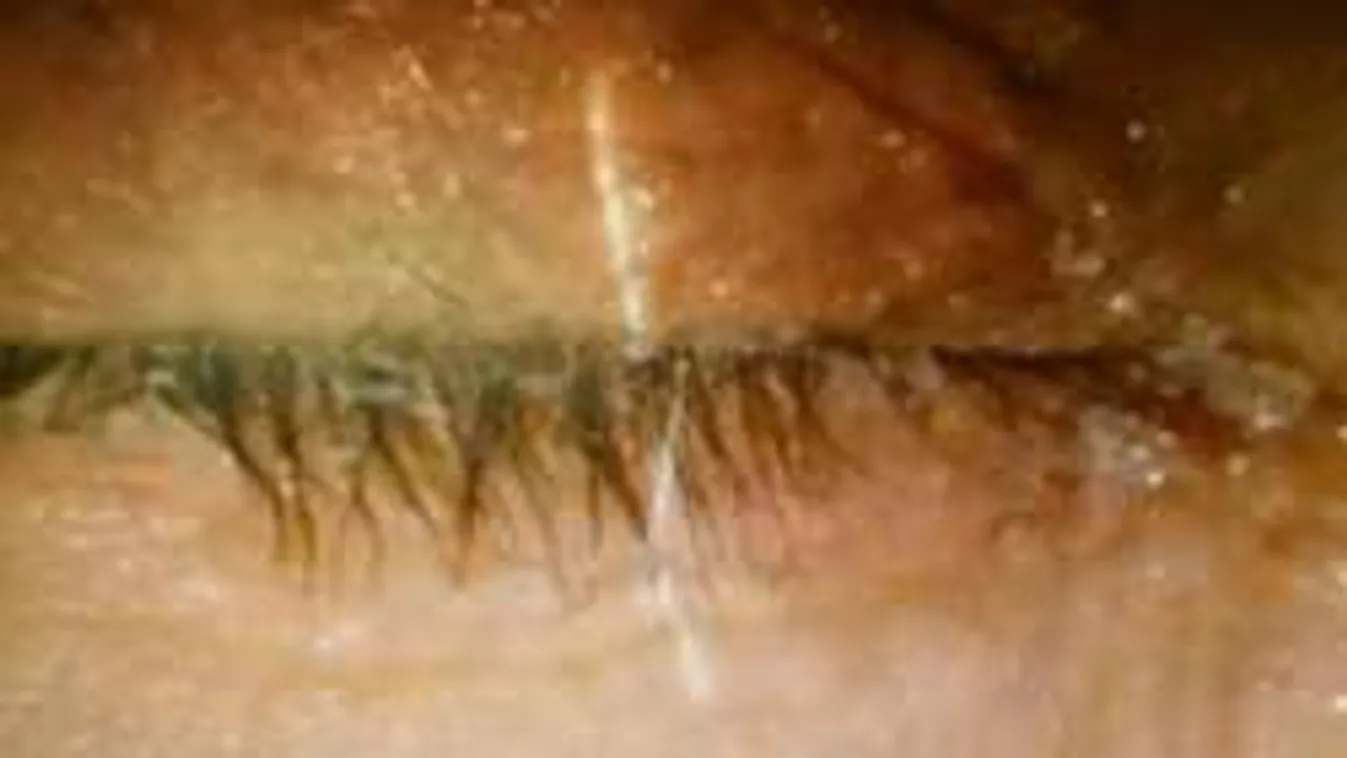 Pillanatragasztót cseppentett a szemébe, szemcsepp helyett egy 19 éves lány