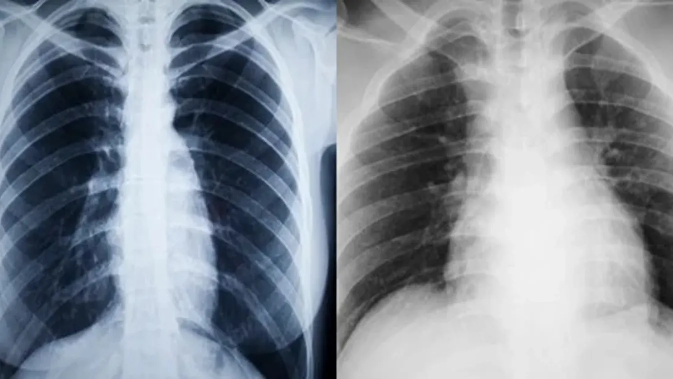 Véletlenül egy koronavírusos donor tüdejét ültették be, a páciens belehalt a fertőzésbe