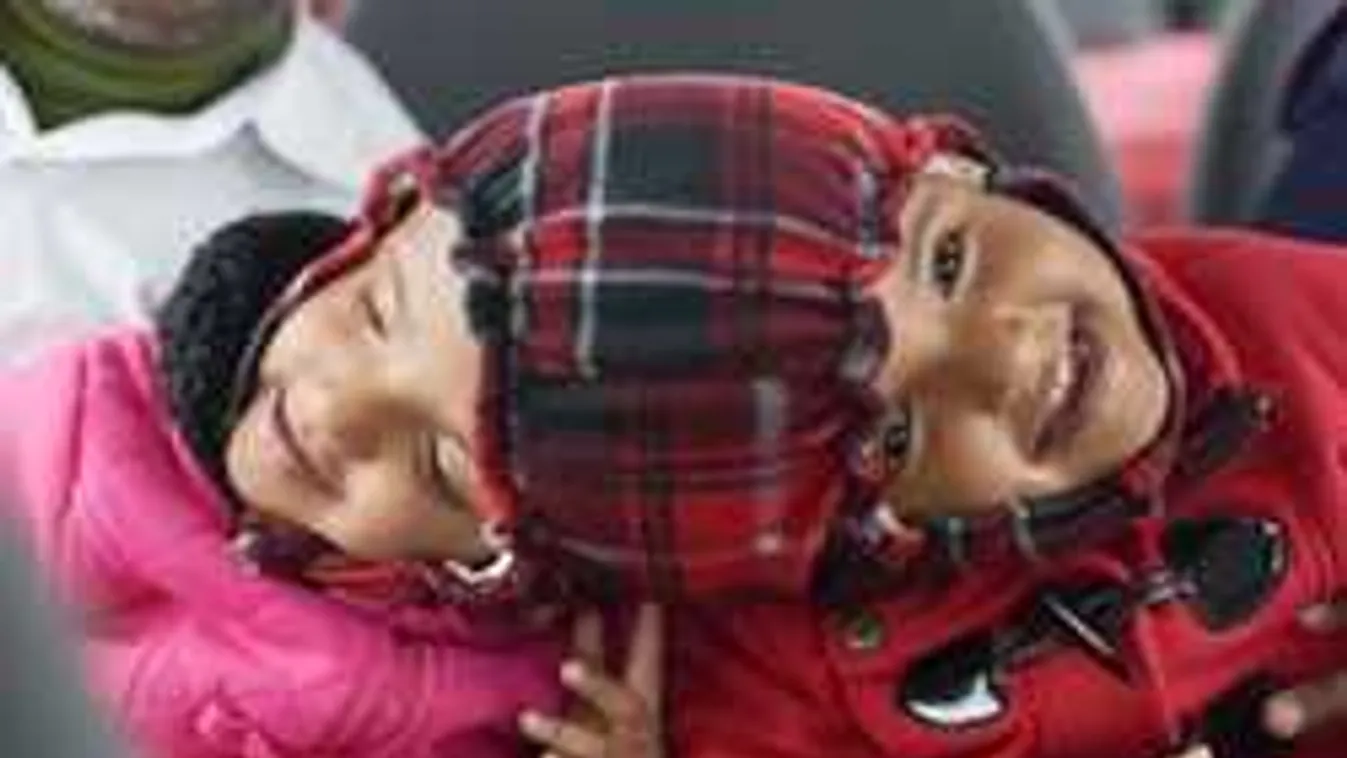 Sapkát varrtak a sziámi ikreknek Budapesten