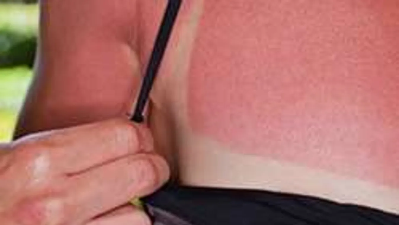 3 hatékony tipp, ha ma szénné égtél a napon