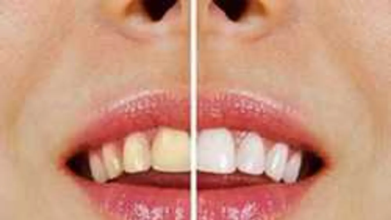 Elképesztő módszerrel lesz ragyogóan fehér a fogad