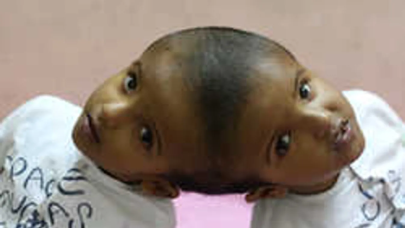 35 tagú magyar csoport segíti a sziámi ikrek szétválasztását