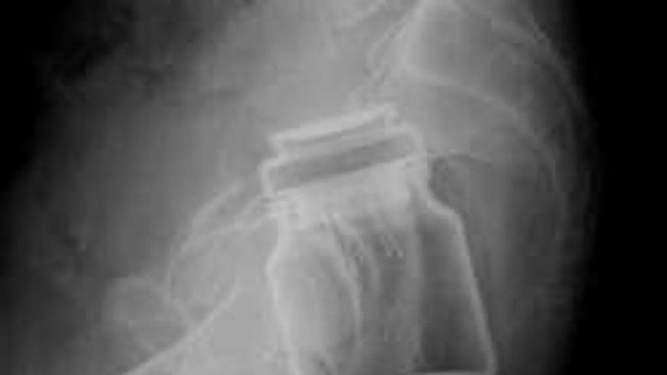 Sokkoló röntgenfotók: bizarr tárgyak, amiket nők vaginájában találtak