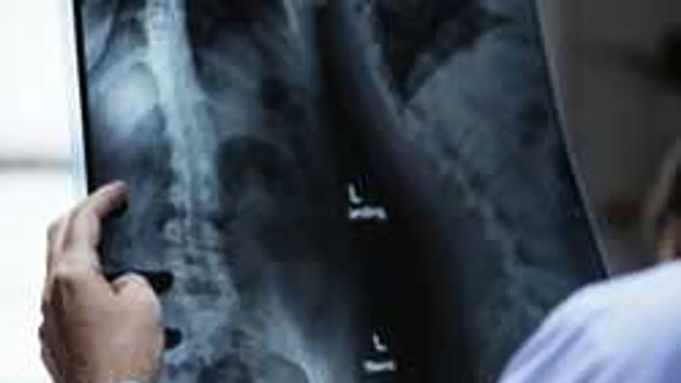 Sokkot kapott az orvos, amikor meglátta a végbélröntgen eredményét