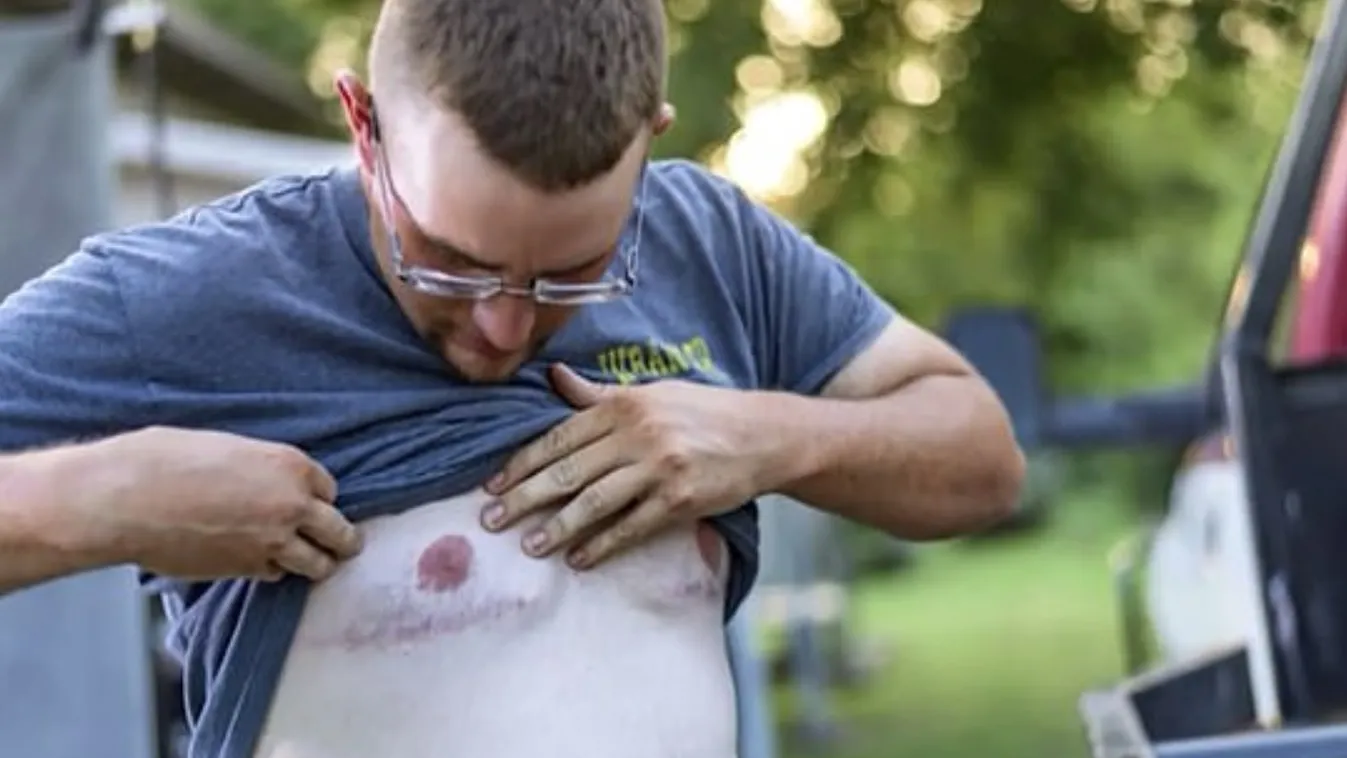 Gyógyszerektől mellei nőttek egy fiúnak, 8 milliárdos kártérítést kap