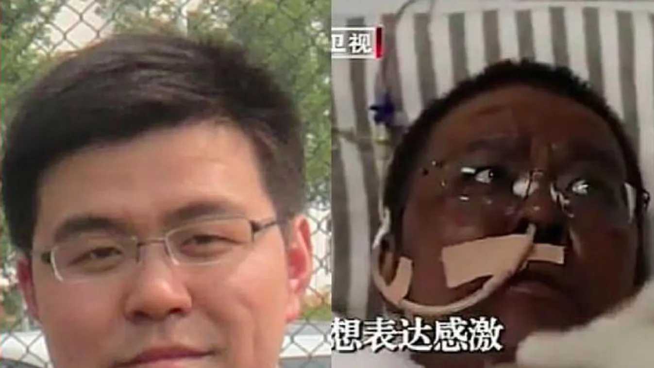 Meghalt az antibiotikumtól elszíneződött bőrű, koronavírusos orvos