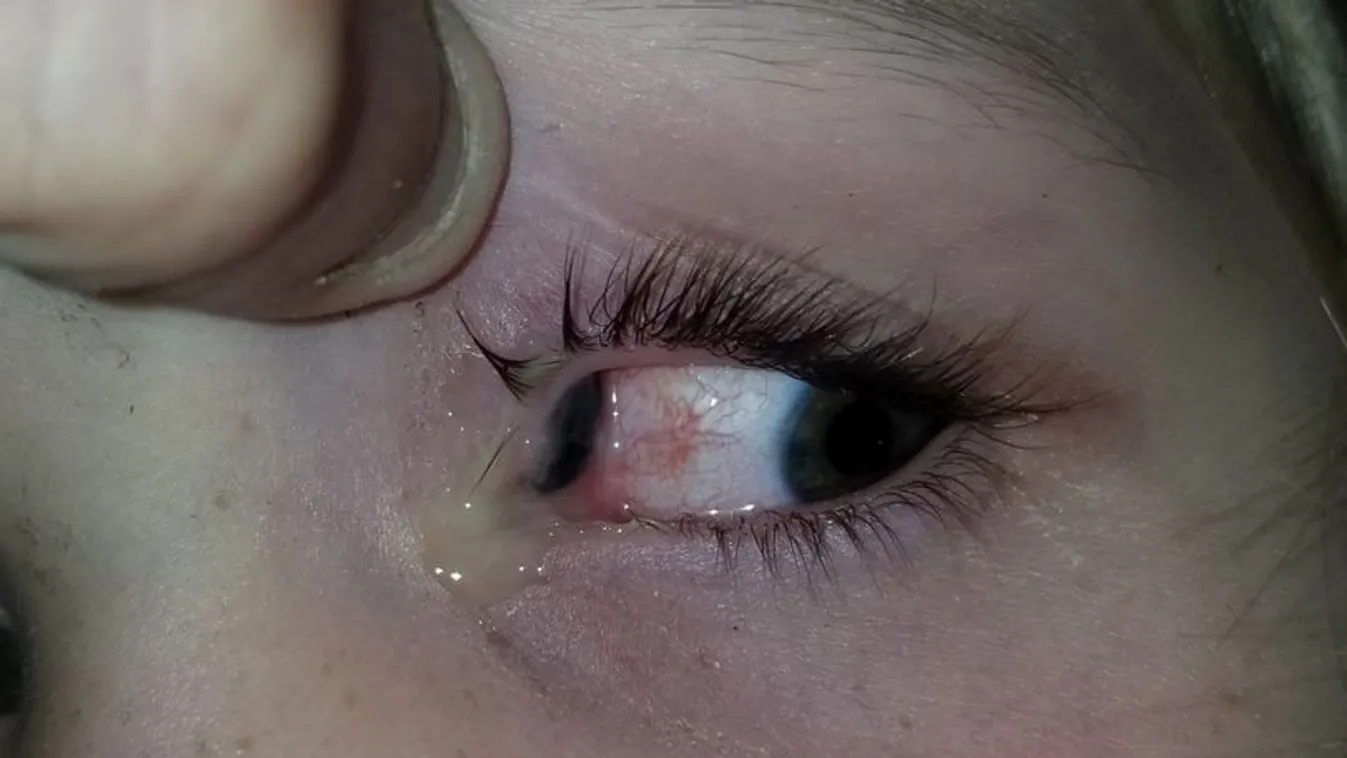 Sokkot kapott az anyuka, szörnyű, mi mászott ki a kislány szeméből – Fotó