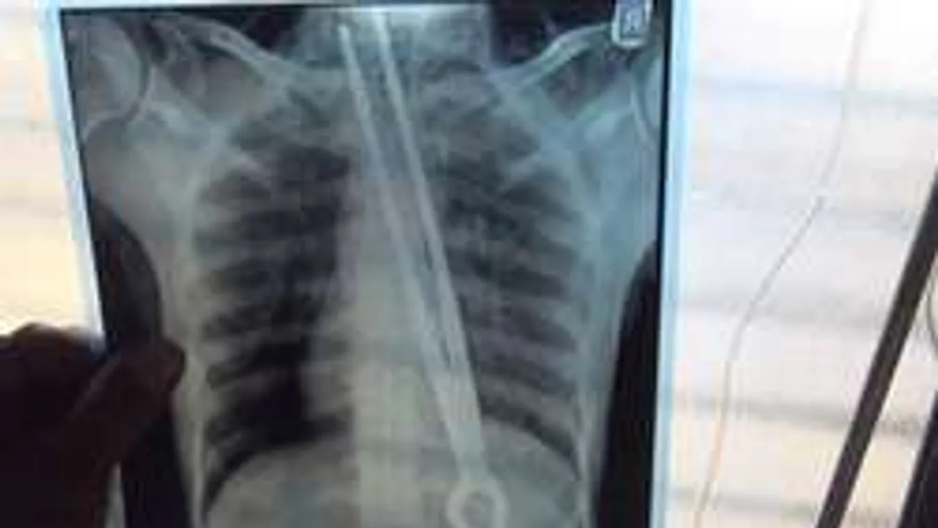 Fogadásból lenyelt egy 30 centis fémfogót! Utána 4 órán át műtötték!