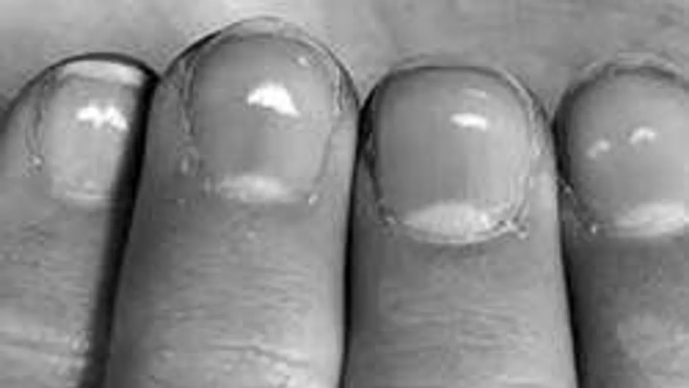 Fehér foltok a körmön - vészjelet küld a tested!