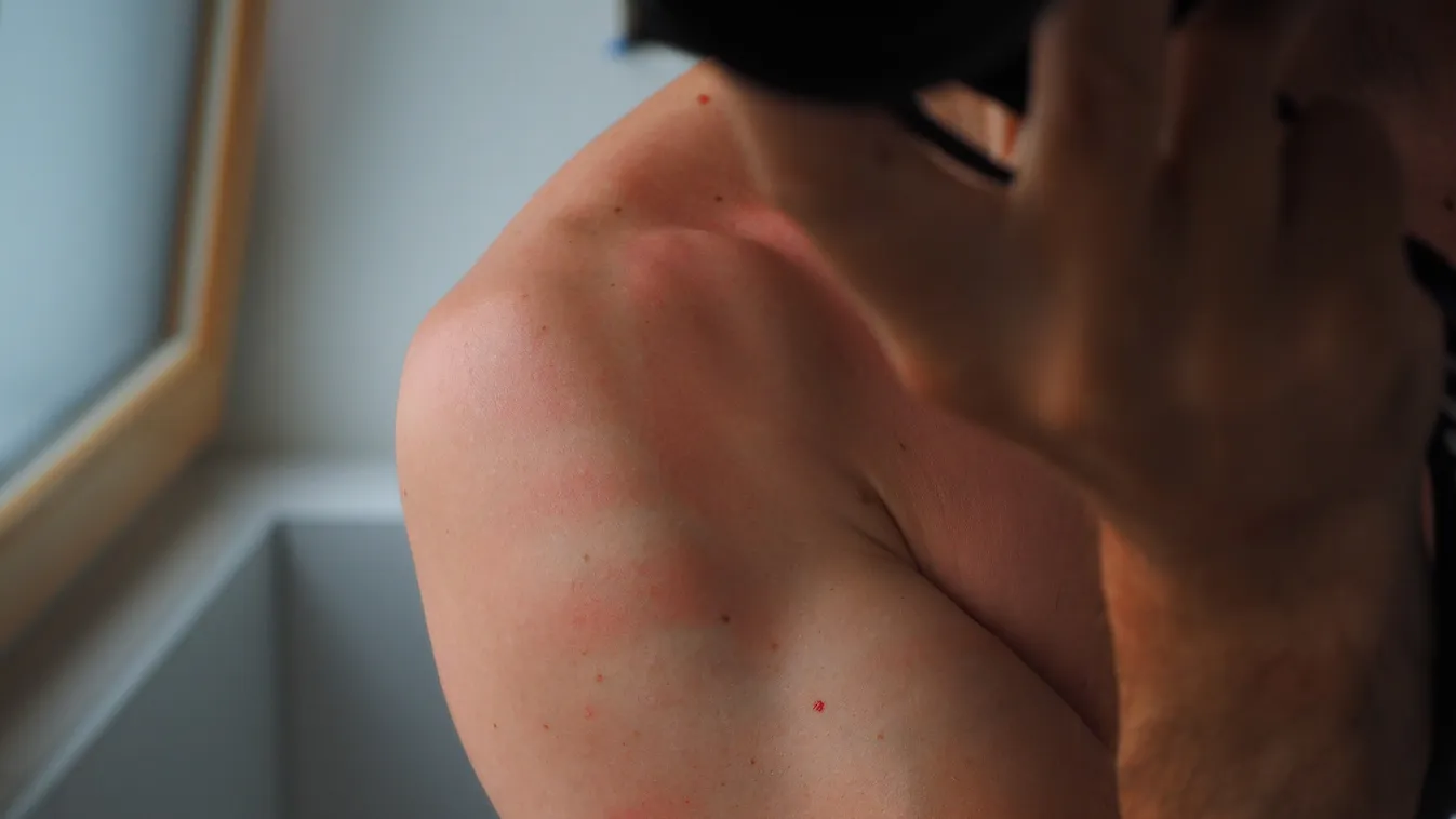 Ezt soha ne kend a bőrödre, ha leégtél