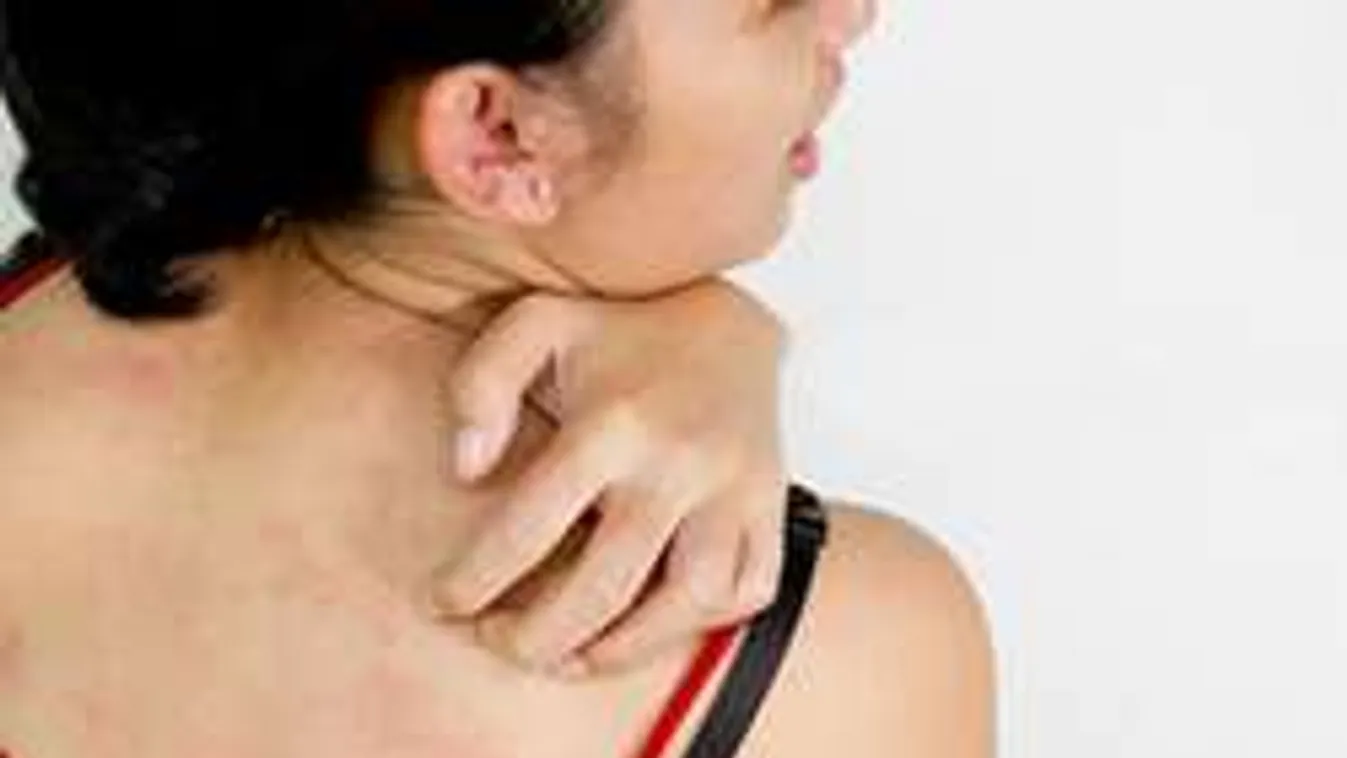 Vigyázz: Rohamosan terjed a szörnyű kiütéseket okozó allergia!