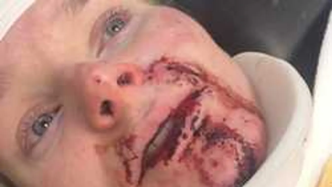 Elgázolták az Eb-győztes sztárt