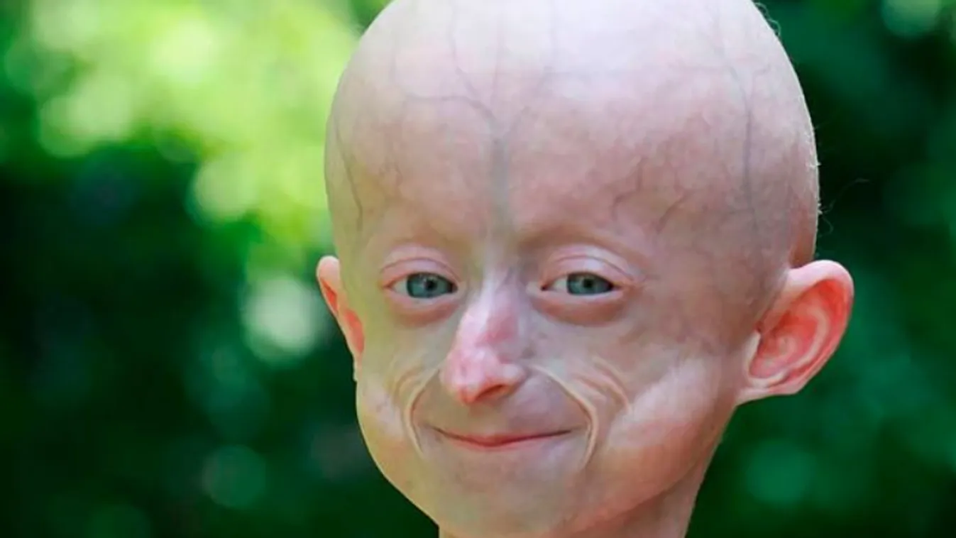 „Sajnálom Napsugár, hogy nem tudtunk megmenteni„- 10 éves korában halt meg a gyorsan öregedő kislány